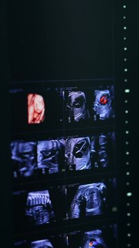 A close-up view of a detailed 3d and 4d ultrasound scan of a developing fetus on a monitor in a modern clinic.