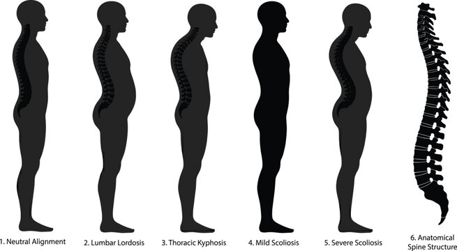 Spine posture deformity silhouettes set, lordosis, kyphosis, scoliosis spinal alignment infographic, vector illustration