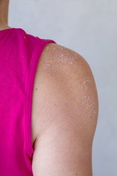 A closeup of a woman shoulder showing peeling sunburned skin with white flakes against tanned skin and a bright pink top