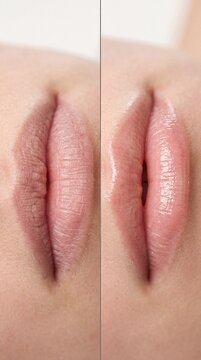 Dry lip chapped lip lip care lip balm hydration split screen before and after close up female healthy smooth repair