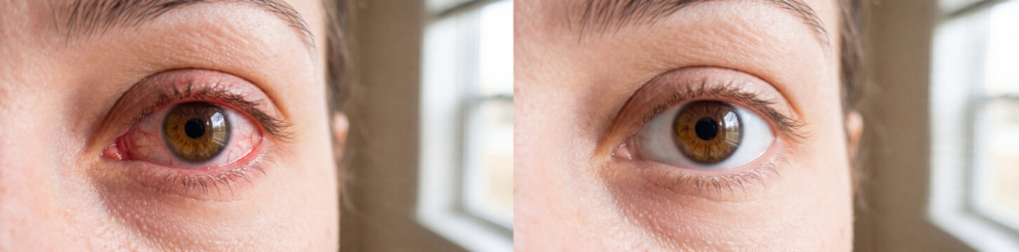 Red Eye Before and After Treatment with Eye Drops, Close-Up Comparison