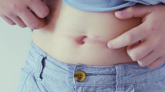Child lifts his shirt to reveal his stomach and shows an iron burn near his belly button, experiencing pain and discomfort that requires medical attention