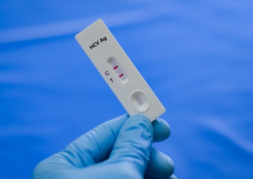Blood sample of patient positive result for HCV Ag.