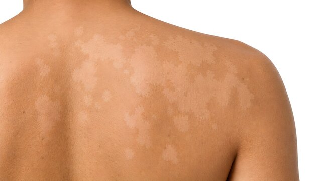 Tinea Versicolor on Upper Back and Shoulder, Hypopigmented Fungal Skin Infection, Realistic Dermatology Medical Illustration
