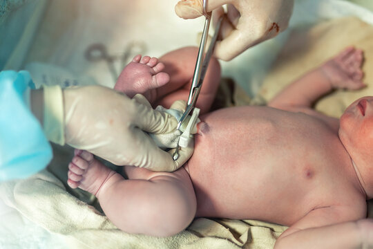Close-up doctor obstetrician nurse cutting umbilical cord with medical scissors to newborn infant baby. Medical surgeon giving birth to child. New human life begin. delivery labor childbirth hospital