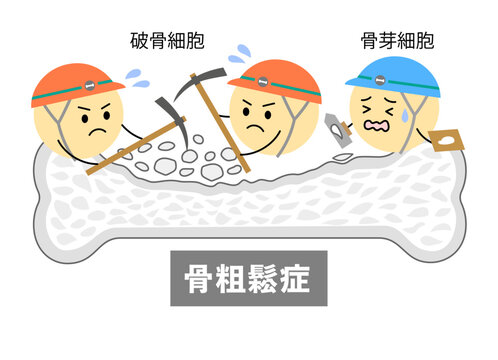 骨粗鬆症になった骨と破骨細胞・骨芽細胞のイラスト