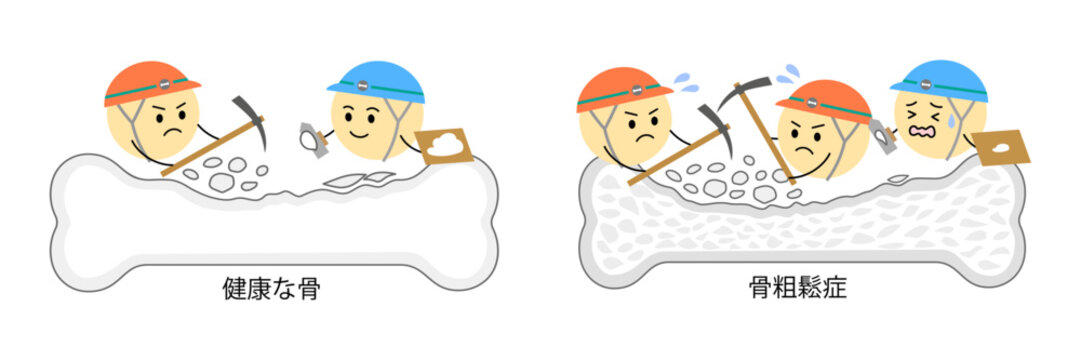 健康な骨と骨粗鬆症になった骨の比較イラスト横