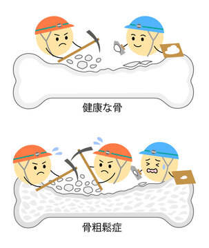 健康な骨と骨粗鬆症になった骨の比較イラスト縦