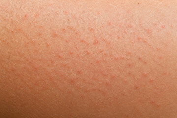 Fototapeta premium Close-up of human skin exhibiting numerous small red bumps, likely a rash or irritation.