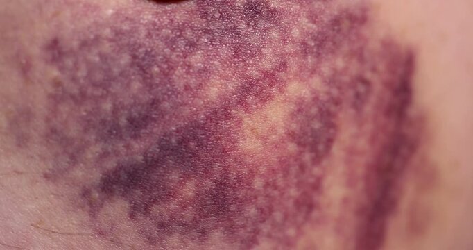 A purple-tinged subcutaneous bruise, a fresh bruise appeared on the soft tissues of the body as a result of domestic injury