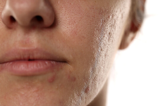 Close up portrait of brunette woman with acne scars, inflamed pimples, enlarged pores and problematic textured skin on white background.