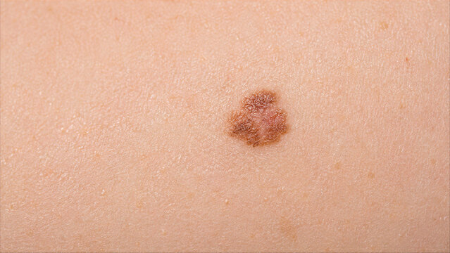 Close-up of an Irregular Nevus or Mole on Human Skin for Dermatological Examination
