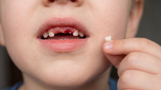 The little child is smiling, showing off their missing tooth, holding a baby tooth that has fallen out of their mouth.