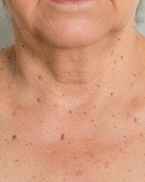Skin Tags on Aging Neck and Chest Close-Up