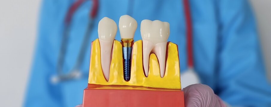 Dentist demonstrates dental implants and crown models in a clinical setting