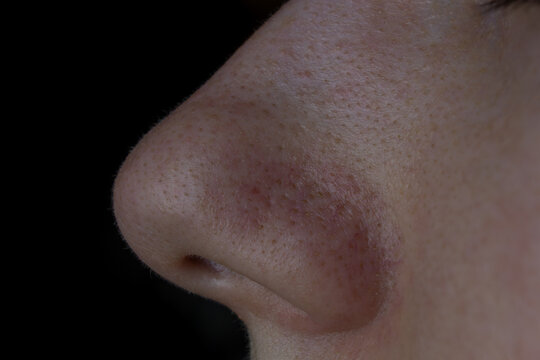 Woman Nose with Blackheads Close Up