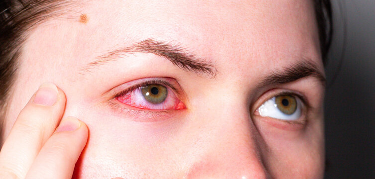 Conjunctivitis making eye bloodshot and swollen. Patient at ophthalmology clinic. Doctor using slit lamp for diagnosis. Eye infection treatment with antibacterial drops