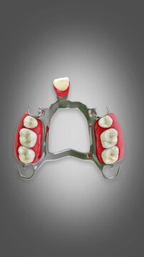 Installation of partial denture into the jaw bone.Medically approved 3D prosthodontic conceptual animation.