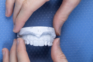 Dental Plaster Cast of Upper Jaw Held with Both Hands on Blue Background © SWMedia
