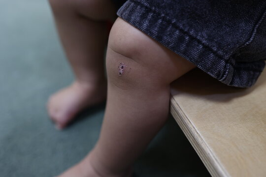 幼児の膝のかさぶた。子どもの怪我の治癒過程。クローズアップ