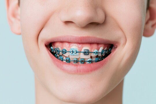 Blue orthodontic braces on the teeth of a smiling young person, a tight close-up showing smooth metal brackets and wire for dental health and correction