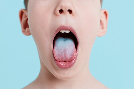 Close up of a childs tongue with a white coating for oral health and medical diagnostics, featuring moist lips and a clinical blue background