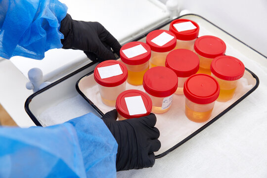 Urine analysis in the laboratory. Medical urine test. Urine sample for laboratory analysis.