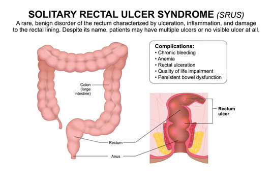 Solitary Rectal Ulcer Syndrome (SRUS)