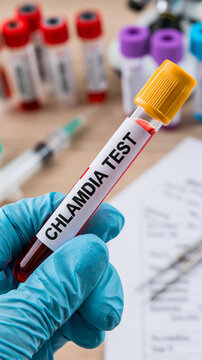 Gloved hand holding a blood sample tube labeled for chlamydia testing in a laboratory, vertical medical concept featuring diagnostics, healthcare and clinical analysis