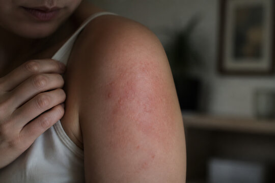 A close-up of a person's shoulder with redness, suggesting a skin irritation or rash.