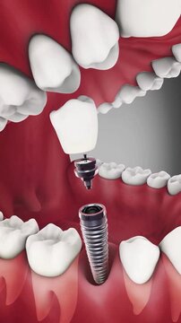 Dental implant 3D animation showing each procedure component implant, abutment and crown separately.	