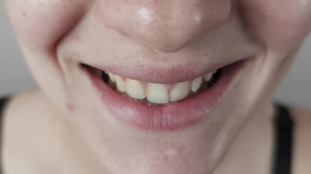 Macro close-up shot captures a female mouth breaking into a wide toothy smile. The authentic joy reveals clean white teeth and imperfect skin with acne against a plain background.