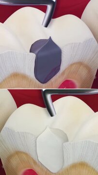 3D animation showing comparison between composite and amalgam dental fillings.