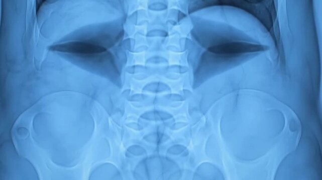 4K X-Ray Image Of Human Lumbar Spine Highlighting Compressed Discs And Vertebrae In Medical Context