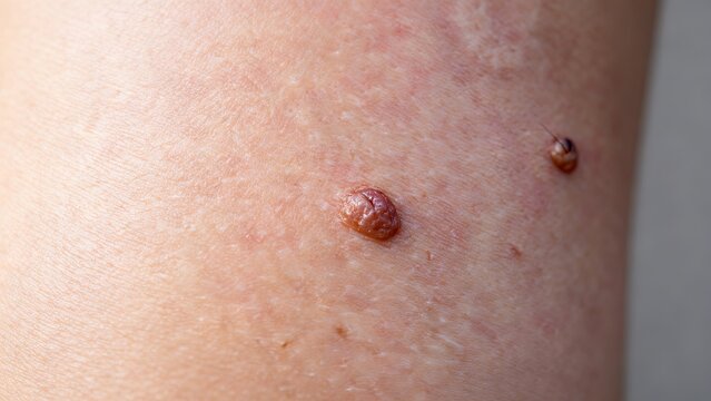 Closeup of skin wart and pigmented nevus on human epidermis, skin lesion clinical reference for dermatology medical use