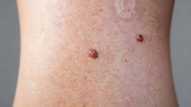 Closeup of skin wart and pigmented nevus on human epidermis, skin lesion clinical reference for dermatology medical use