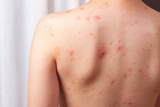 the child is standing with his back, he has a papular rash on his skin. Chicken pox,