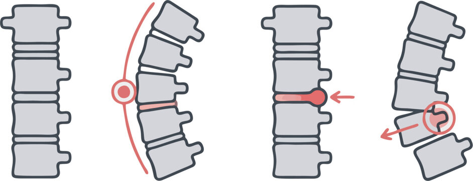 Spinal Disc Herniation Stages Medical Illustration, Intervertebral Disc Degeneration, Spine Anatomy, Herniated Disc, Back Pain, Orthopedic, Medical Diagram, Vertebrae