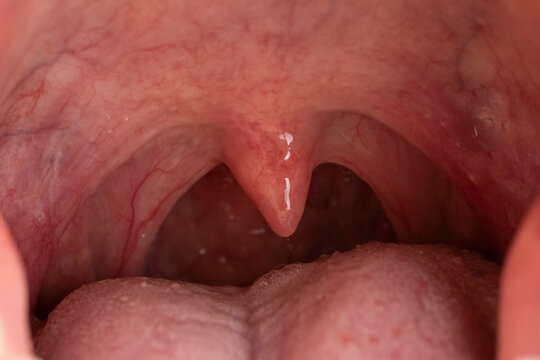 Close-up inside view of a human mouth showing the open throat, uvula, soft palate, and tonsils.