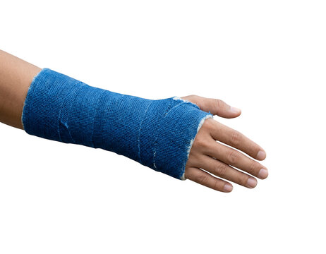 Blue fiberglass arm cast on patient hand, medical orthopedic wrist splint for bone fracture, healthcare recovery and injury treatment isolated on Transparent Background