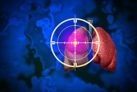 Precision Oncology and Personalized Gene therapies Lung Cancer Treatment and Small Cell Lung Cancers as a Central malignant tumor growth as a Metastasis growing in the lungs from a bronchi as a bronch