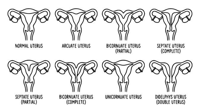 Uterus Anatomy and Congenital Anomalies Diagram