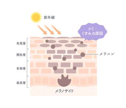 紫外線によるシミ・くすみの原因とメラニン生成を解説する肌断面図イラスト
