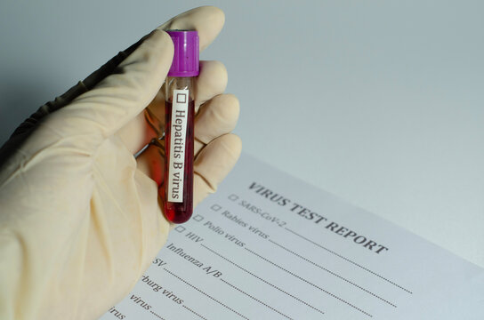 Medical professional in glove holds blood sample for Hepatitis B virus testing near virus test report form