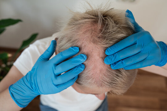 A top view of a woman's head showing hair loss and baldness. Hair loss due to chemotherapy. Baldness due to chemical intoxication.