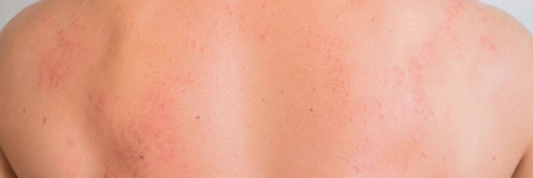 Close up of irritated red rash on human back skin, dermatology, allergy, healthcare, skin condition