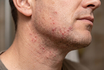 Fototapeta premium Man shows skin condition on his neck in a close-up taken indoors during daytime hours
