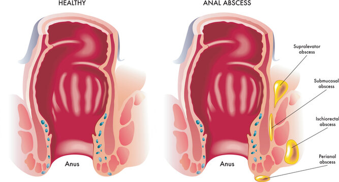Anal abscess.eps