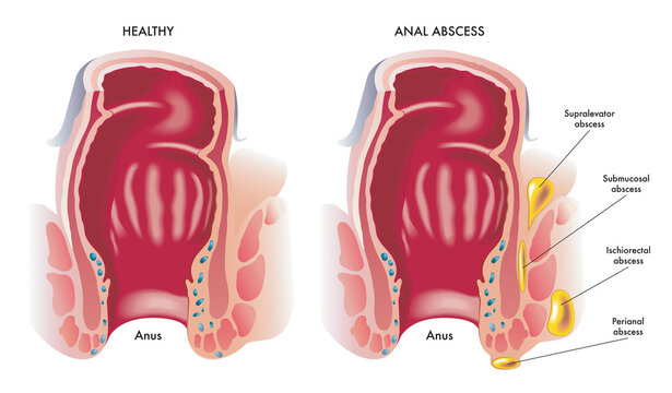 Anal abscess.jpg