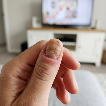 Close-up of hand with damaged fingernail
